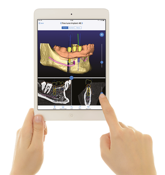 Picture for category Guided implantology