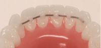 Picture of SS Flat Braided Lingual Retainer